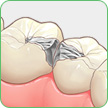 銀歯の詰め物（インレー）での治療