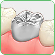 銀歯の被せ物（クラウン）での治療