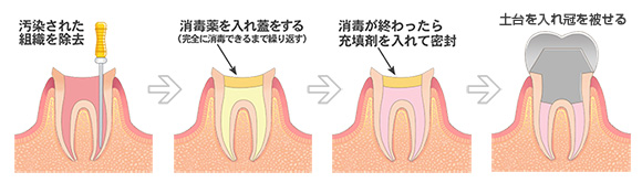 神経の治療をした後、被せ物をする治療