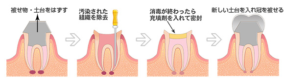 炎症を抑え、神経の治療をした後に、被せ物をする治療