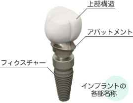 インプラント治療